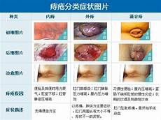 内痔的佳治疗方法